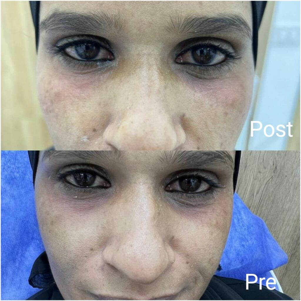 Dark circles filler before and after